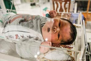 Medical team successfully separates conjoined twins
