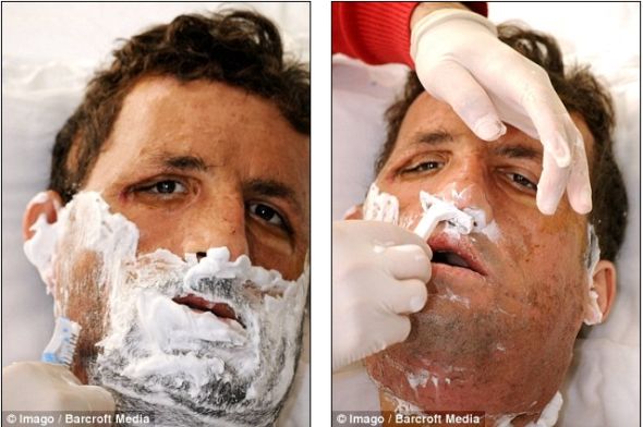 土耳其换脸人手术后首次长出胡子