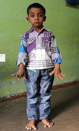 印度4岁男童患病长13根手指和12个脚趾(图)
