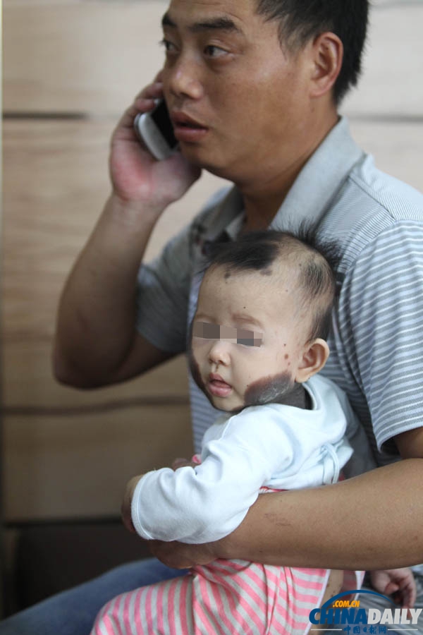 “斑点宝宝”赴上海求医