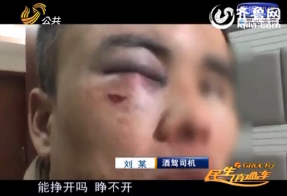 济南：酒后斗殴被打满脸伤痕 男子酒驾求救警察