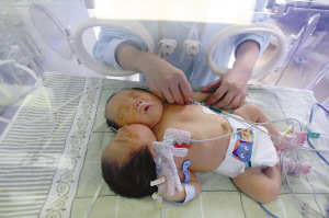 双头女婴已活27天 心肺不堪重负多次濒临死亡