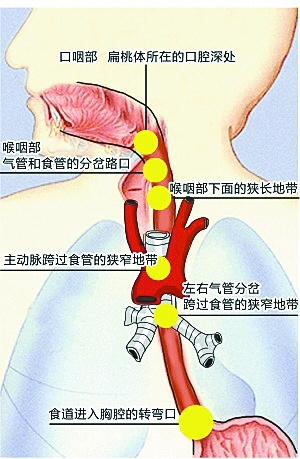 男子鱼刺卡喉身亡 医生: 吞饭喝醋等土方法更要命