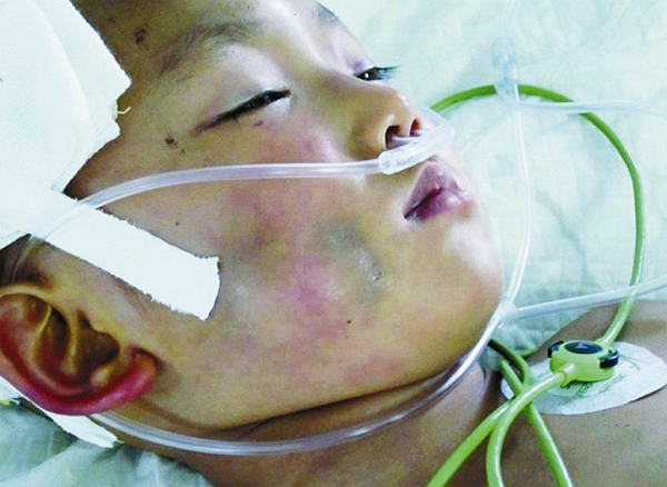 3岁男童被母亲打至昏迷不醒 已开颅尚未脱离生命危险