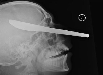 英国小伙头插餐刀大难不死 惊悚X光片吓坏法官