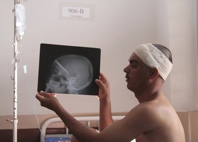 巴西男子脑中插10厘米刀刃3年 “玩命”手术成功