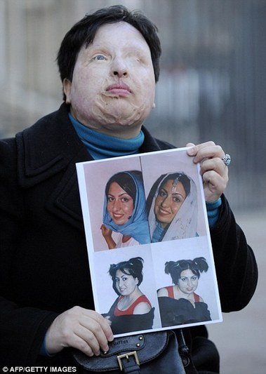 伊朗被泼硫酸女子不再“以眼还眼” 索赔200万欧元