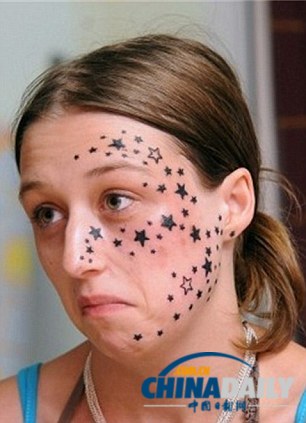比利时女孩半边脸文满星星 激光治疗3年彻底清除