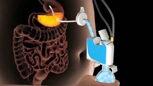 多余食物从胃里抽出？新发明让你不担心卡路里摄入