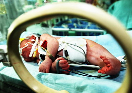  A 'mermaid boy' lies on a bed at a hospital in Changsha, Central China's Hunan Province, November 21, 2006. The body succumbed to multiple organ failure a little more than a month after he was born. His legs, just 21 centimeters long, were joined together from thigh to heel, with the feet splayed out so that they resembled a fish tail. 