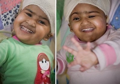 1 conjoined twin talking after separation surgery