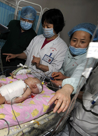 Conjoined twins successfully separated in Hunan