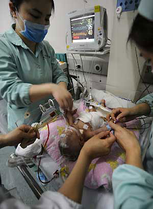 Conjoined twins successfully separated in Hunan