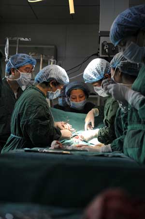 Conjoined twins successfully separated in Hunan