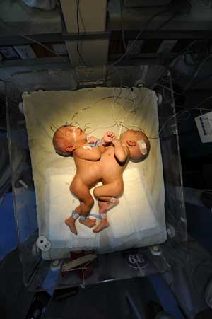 Conjoined twins separated and healthy