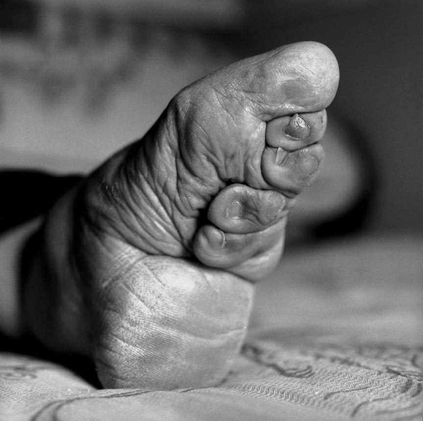 Chinese women with bound feet