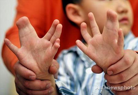 Boy with 31 fingers and toes ready for operation