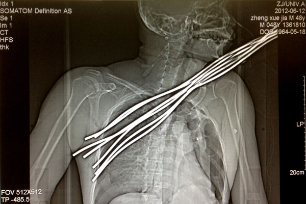 Critical procedure to remove iron bars in body