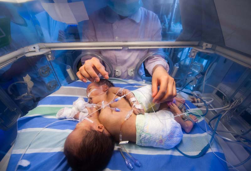Doctors consider separating conjoined twins
