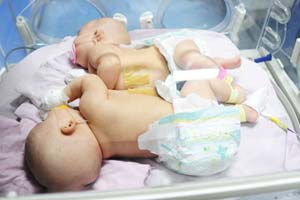 Doctors consider separating conjoined twins