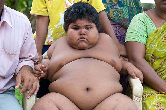 印度女孩5岁150斤医生担心活活吃死