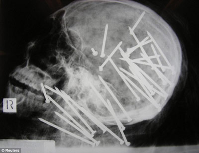 澳洲一华人男子被杀抛尸河中 头颈内有30枚钢钉