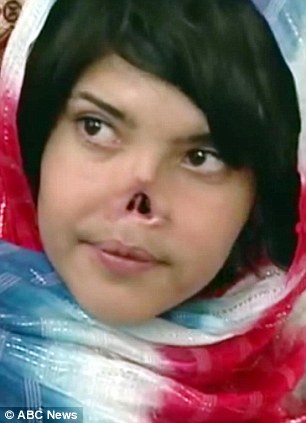 阿富汗遭割鼻女孩整容后亮相(组图)