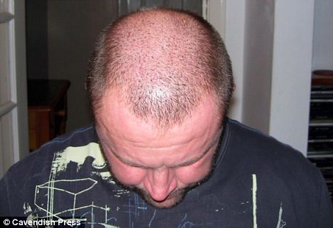 纳米纤维酷似头发 英男子花15英镑告别“秃顶”