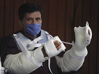 墨西哥截肢男子接受双手移植 系拉美首例