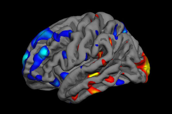 Handout shows brain differences in autism patient