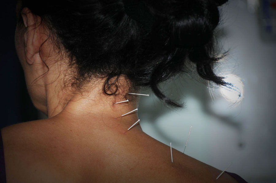Acupuncture treatment in Malta