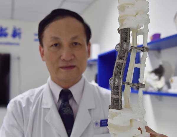 Chinese doctors succeed in rare 3D-printed vertebrae implant