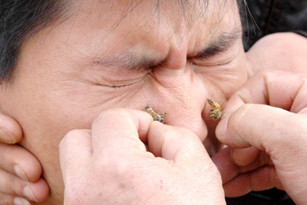 A Chinese man receives treatment with bee venom for rhinitis, an inflammation of the nasal membranes, at a clinic in the Duqu Town of Xi'an, West China's Shaanxi province, April 4, 2006. The doctor of the clinic Li Qixing uses bee venom released into the patient's body when the bee stings, to cure diseases such as rheumatism, arthritis and rhinitis. Picture taken April 4, 2006. 