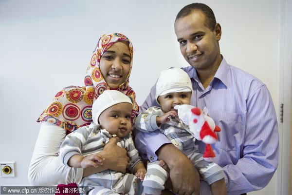 Conjoined twin girls separated