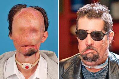 US woman gets full face transplant