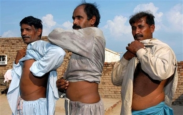 Pakistani farmers who sold their kidneys, show scars Oct. 17, 2006 in Jandala near Multan, Pakistan. Debt and poverty is driving hundreds of Pakistanis to sell their own kidneys for cash, turning this South Asian nation into a regional hub for unregulated, cut-price transplant operations. (AP 