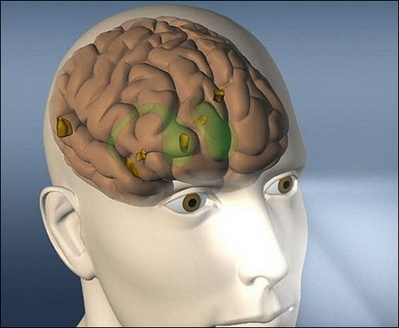 A computer image mapping parts of the brain. Strokes cause brain damage within three minutes, scientists reported Thursday, casting doubt on the common public perception that all strokes can be medically treated within three hours. 