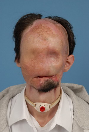 Texas man gets first full face transplant in US