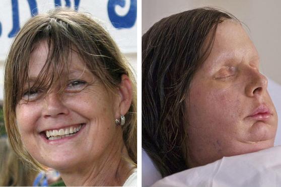 US woman mauled by chimp shows new face